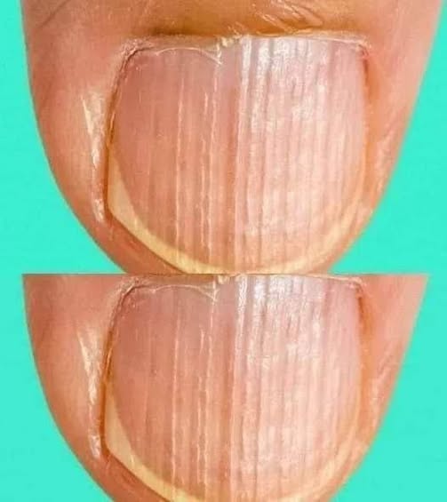 Having Striped Nails Could Mean That Your Body Is