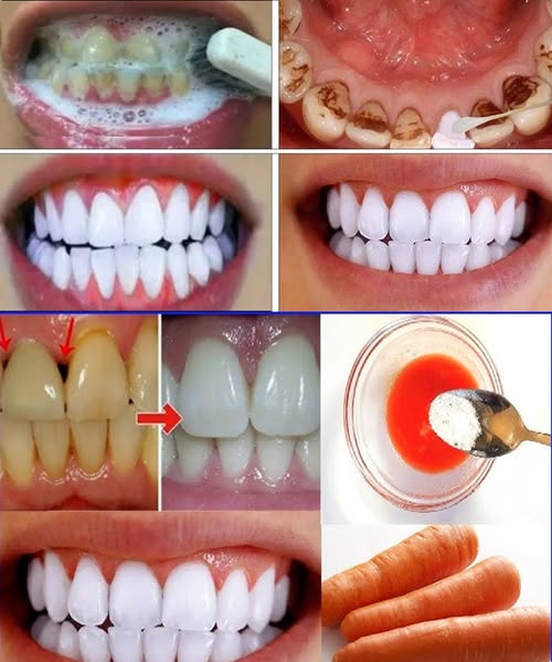 How to Whiten Your Teeth Fast